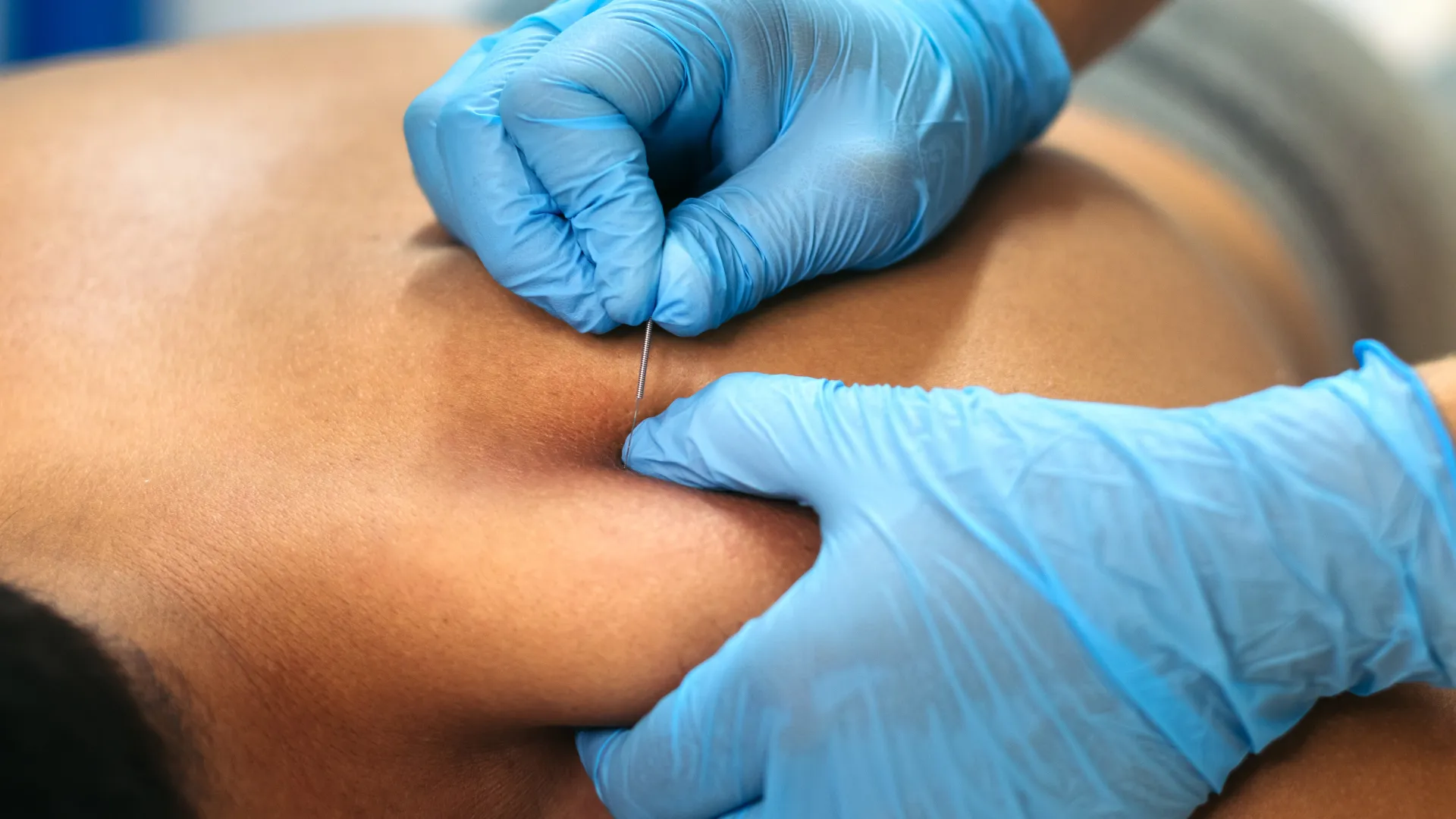 Primer plano de un fisioterapeuta con guantes azules realizando punción seca con una aguja fina en el hombro de un paciente.