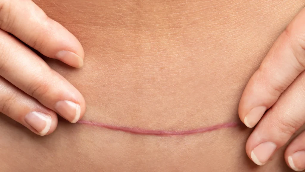 Cicatriz quirúrgica lineal sobre la piel del abdomen, sostenida suavemente con los dedos de ambas manos, mostrando una fase de cicatrización avanzada con tono rosado.