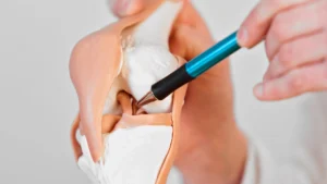 Modelo anatómico de una rodilla humana que muestra huesos y músculos, mientras un bolígrafo señala el ligamento cruzado anterior en el interior de la articulación.